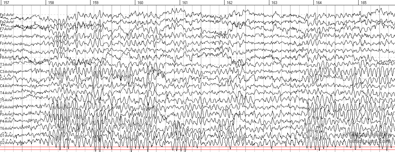 Picture of 19 channel EEG readout